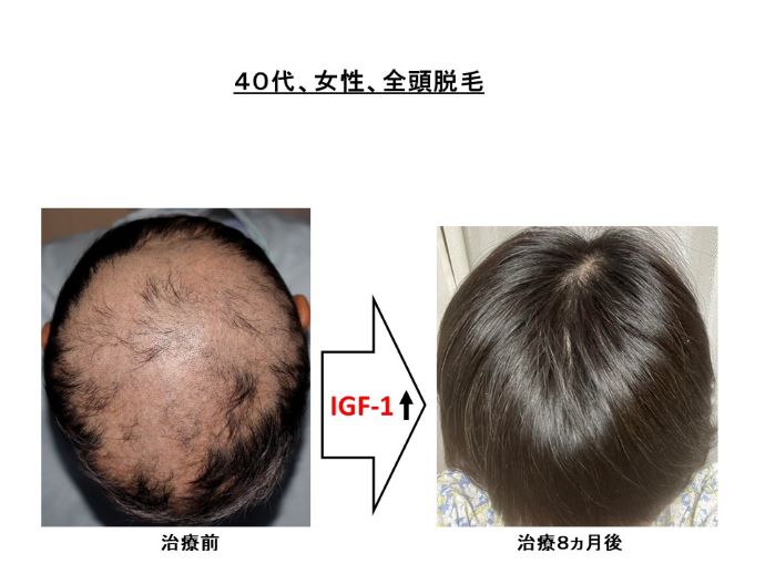 円形脱毛症　病院